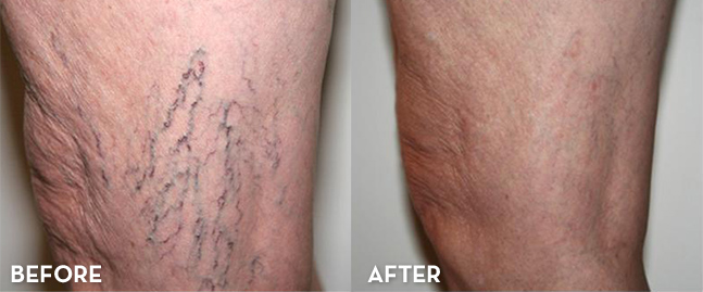Before and After Spider Vein Treatment