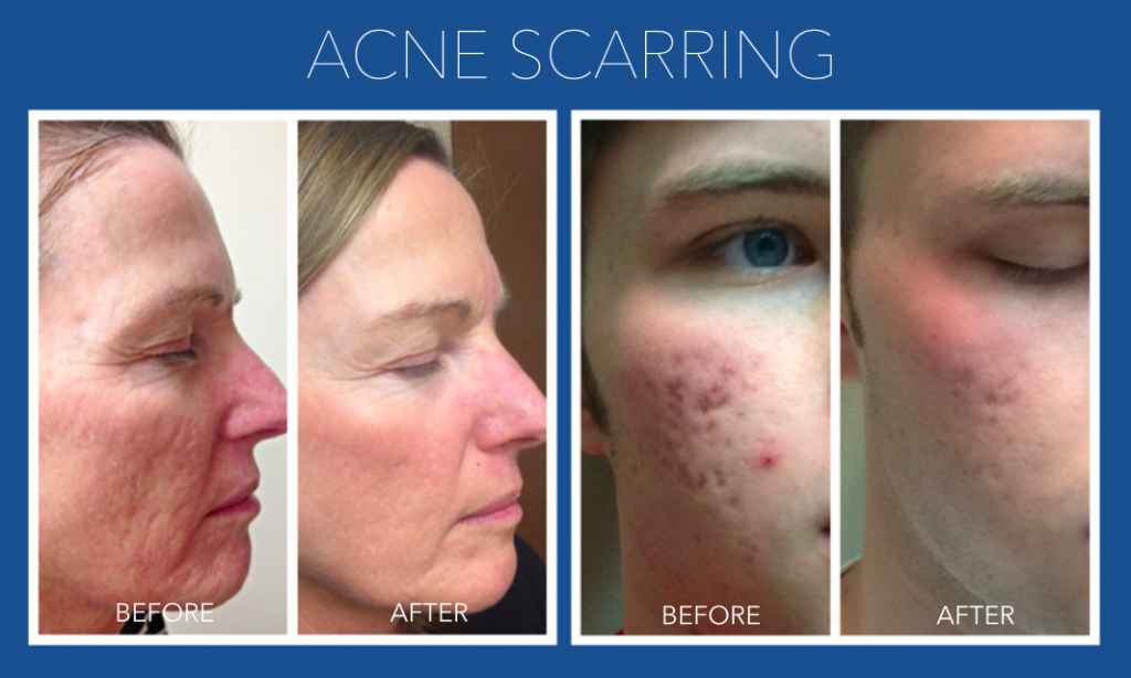 Acne Scarring - Micro Needling Springfield MO