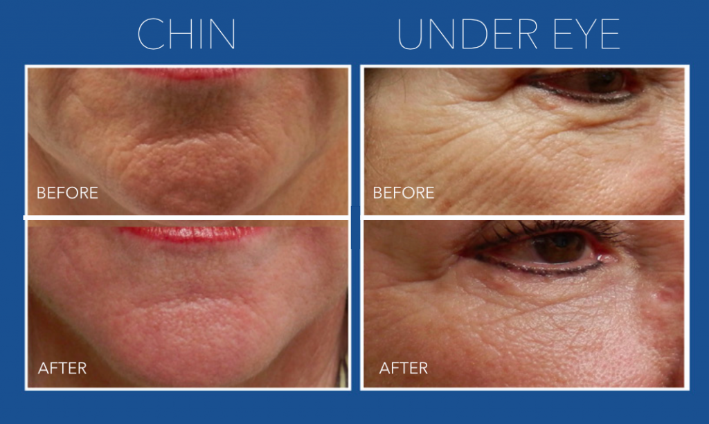 Chin and Under Eye - Micro Needling Springfield MO