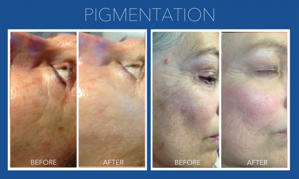 pigmentation-micro-needling-springfield-mo