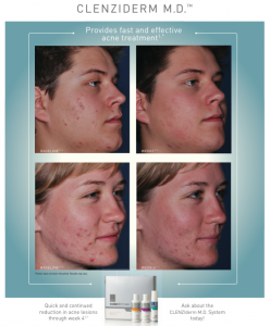 Clenziderm Before and After - Skincare Solutions For Teen and Adult Hormonal Acne Springfield MO