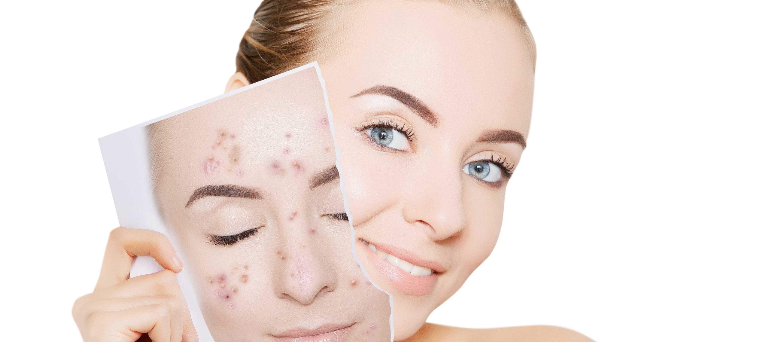 Improve Your Teen's Complexion With Acne Treatments in Springfield Missouri