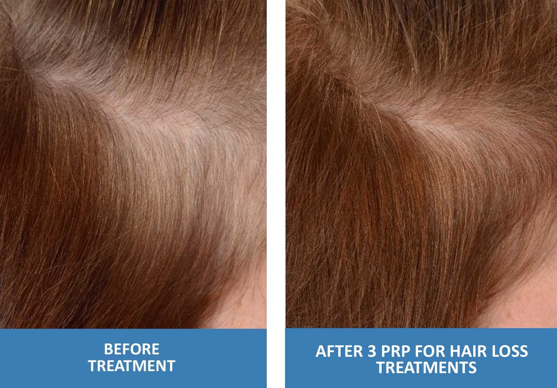 PRP For Hair Loss Before And After Photo Female 3 Treatments Platelet Rich Plasma in Springfield Missouri