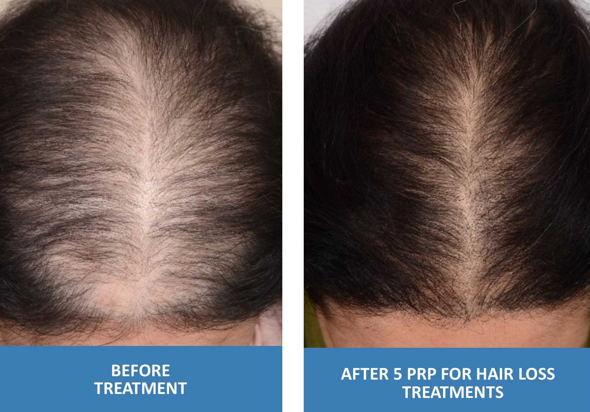 PRP For Hair Loss Platelet Rich Plasma in Springfield Missouri