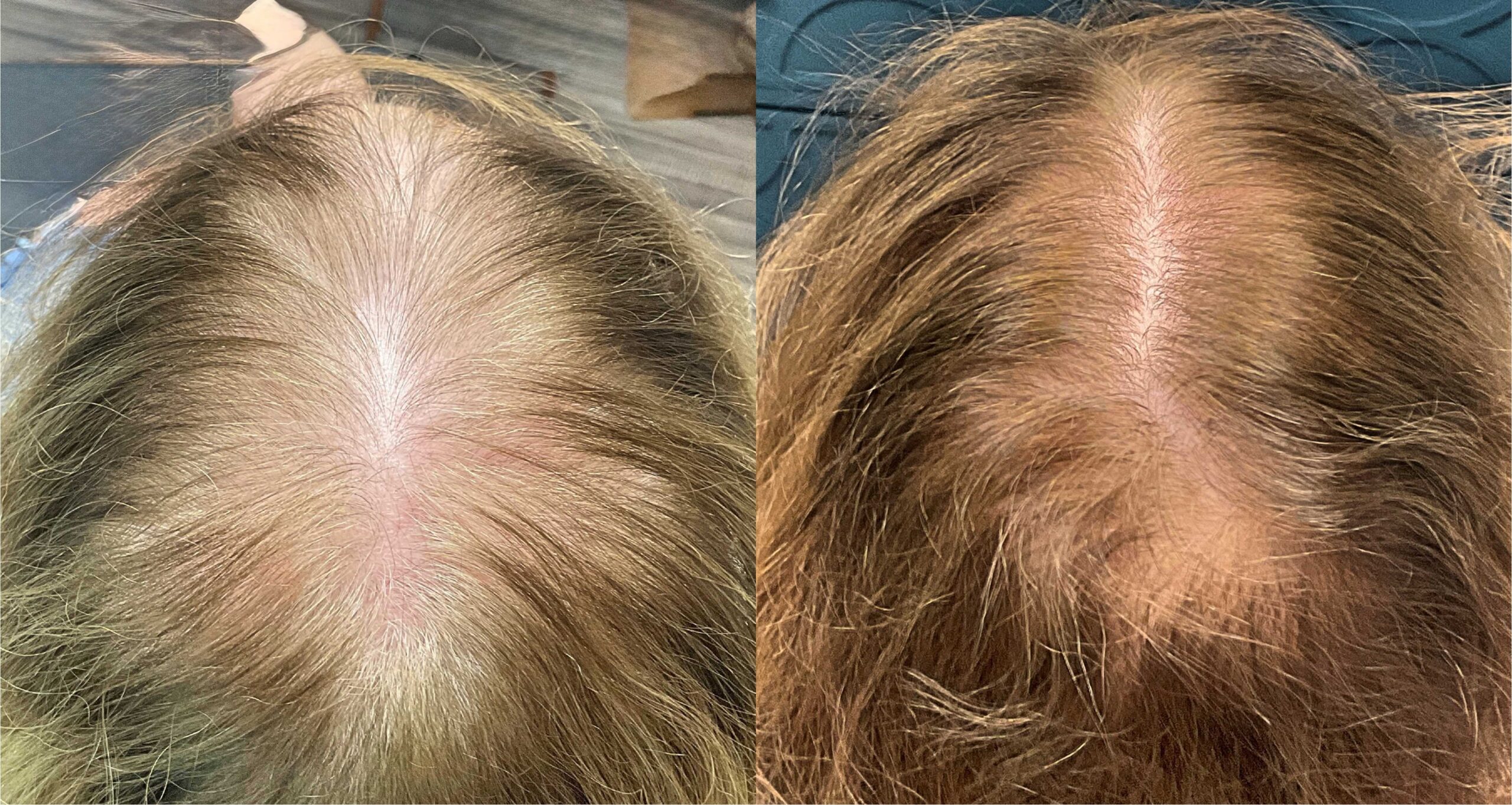 Fotona HAIRestart Laser Hair Loss Treatment Springfield Missouri Before After Customer Top View Part