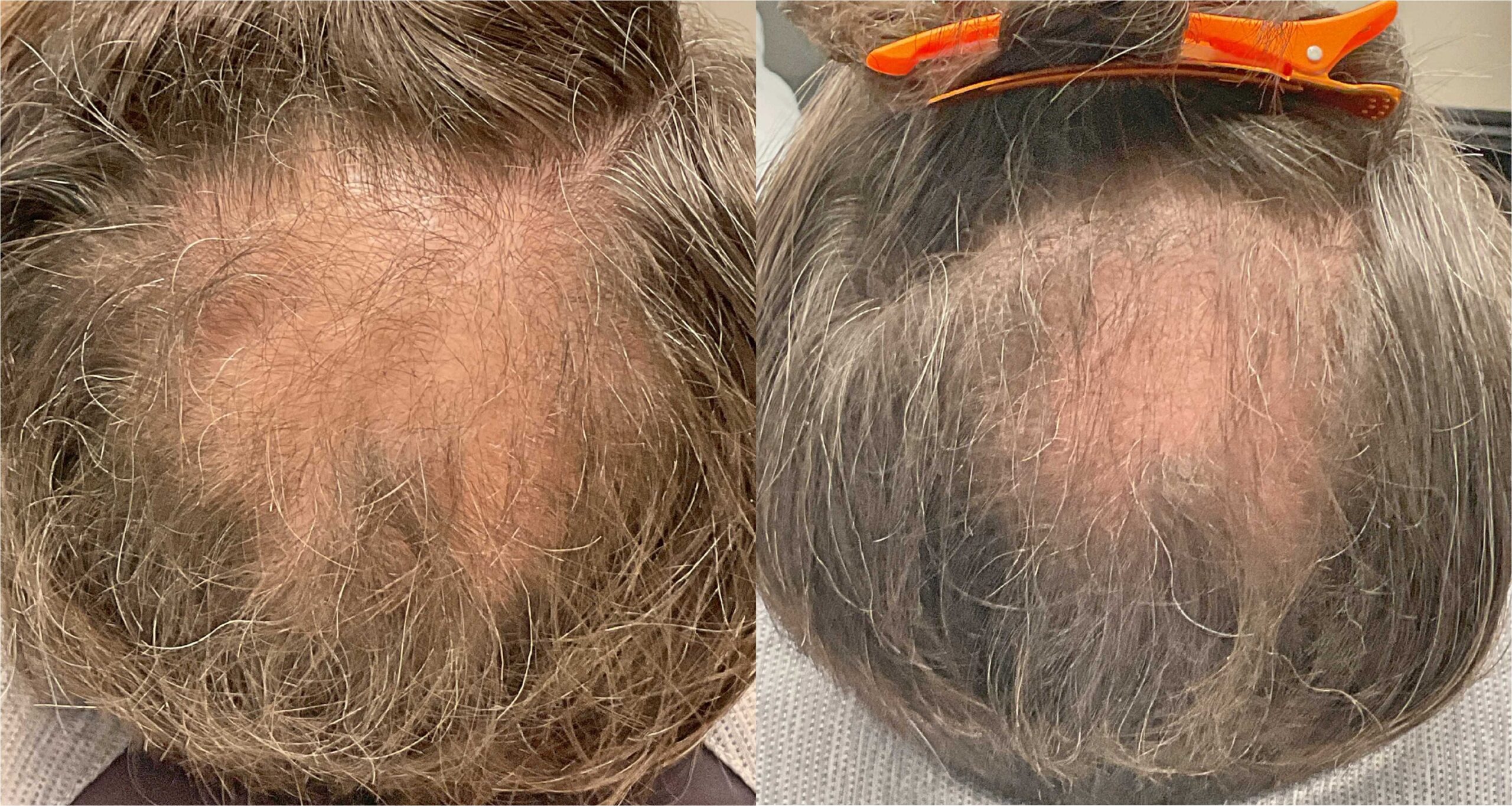 Fotona HAIRestart Laser Hair Loss Treatment Springfield Missouri Before After Customer Top View